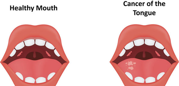 Рак языка