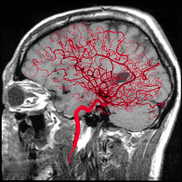МРТ сосудов головного мозга