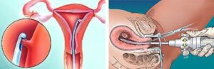 Рак эндометрия (рак тела матки) - симптомы и лечение