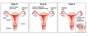 Рак яичника и маточной трубы