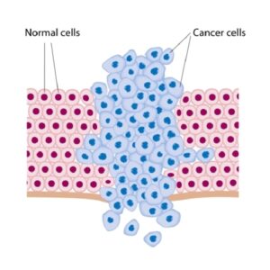 Рак яичника и маточной трубы
