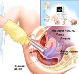 Рак эндометрия (рак тела матки) - симптомы и лечение