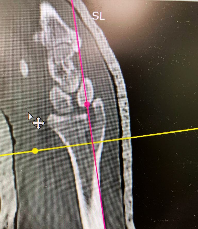 Лечение перелома лучевой кости без наложения гипса - Hadassah Medical ...